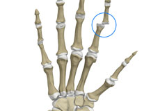 Finger Joint Dislocation and Volar Plate Injury